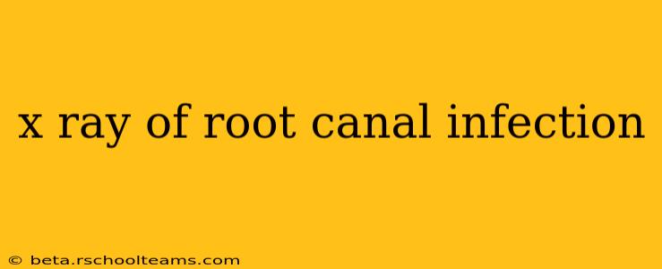 x ray of root canal infection